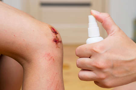 Woman sprays an antiseptic agent on the wound on the childの写真素材