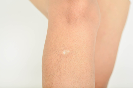 Ugly scars on the woman's legs