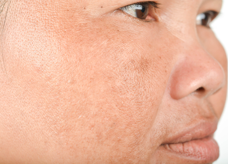 Freckles on the faceの写真素材