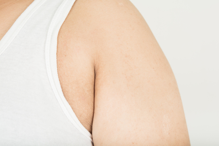 Upper arms and subcutaneous fat  woman.の写真素材