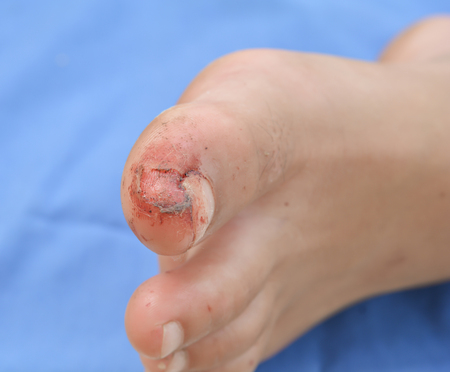 Wound from knee fallの写真素材