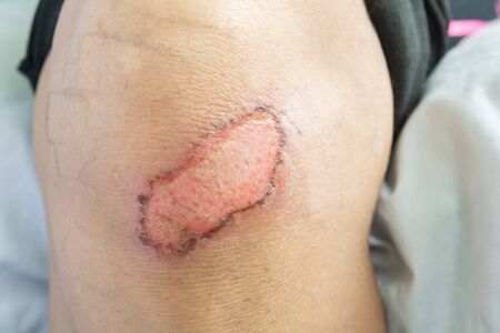 Lesions and knee injuries. Lesions from accidentの写真素材