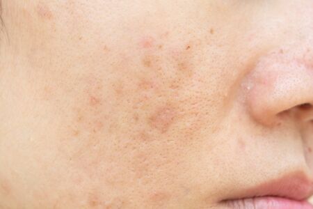 Acne scars and pores. Dark spots. Wrinkles and skin problemsの写真素材
