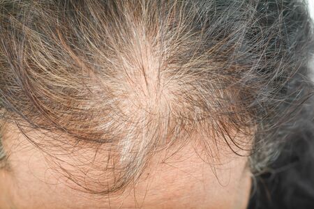 thin hair in women