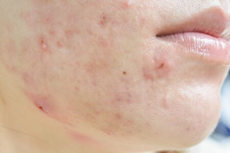Scar from Acne on faceの写真素材