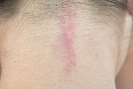 Rash of allergies