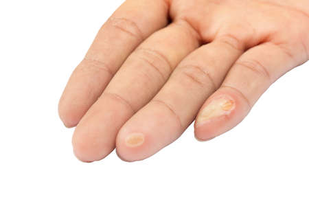 blisters on finger caused by electric shockの写真素材