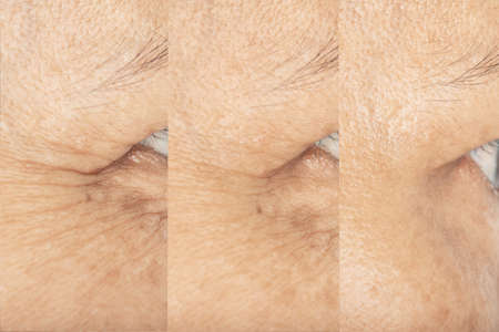 Wrinkles on the eyes