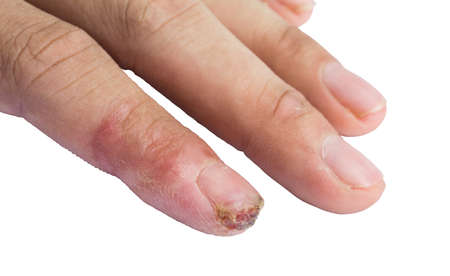 Finger wound