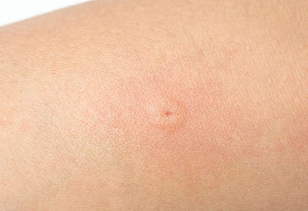 Blister from insect bites