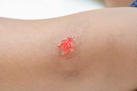 Wound from knee fall