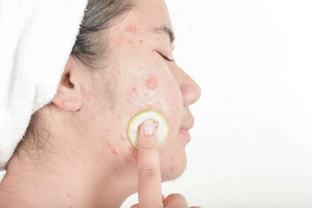 Cucumber and skin in teens