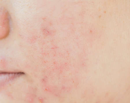 Acne and from scar on face