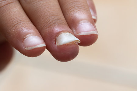 Macro of the fingers of a child who is losing a fingernail after trauma.の写真素材