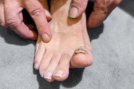 A closeup view of a man barefoot with a yellow and thick big toenail, onychomycosis, a fungal infection of toe nails.の写真素材