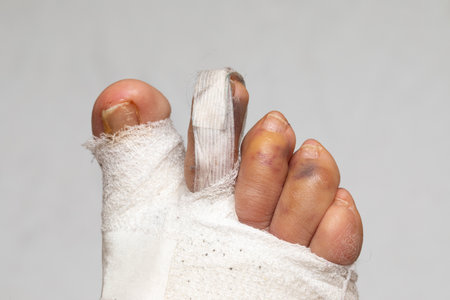 Postoperative correction of hallux valgus, details of bandaged fingersの写真素材