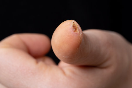 dermatological abrasion and crust on fingerの写真素材