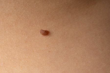 Close up of a mole on the skin of a young woman.の写真素材