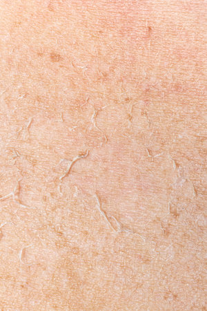 Macro of human dry skin damaged by sun uv rays. Close-up of a Caucasian woman's arm with dry flaking...