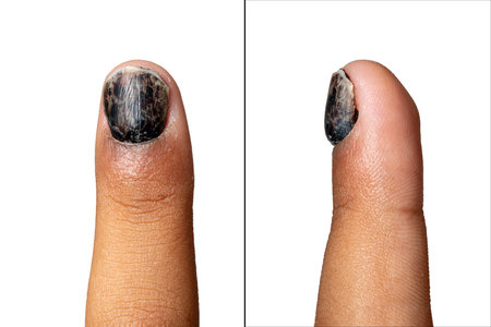 Black nail due to crush trauma. Hematoma causing the nail to become detached. Top and profile view isolated on white background.の写真素材