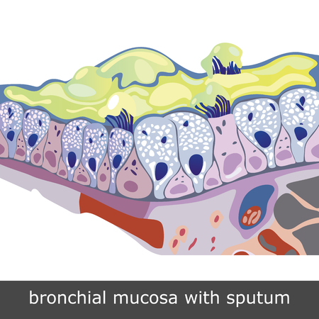 Structure of damaged bronchial mucosa with sputum, vector illustration