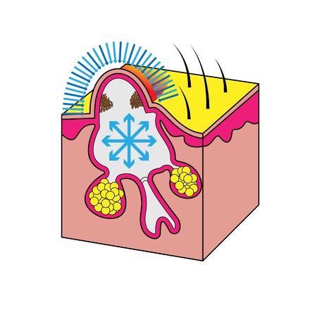 Formation of acne papule and pimples, medical vector illustrationのイラスト素材