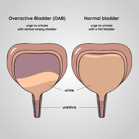 Overactive and normal bladder. Urinary system disease. Urology. Medical flat vector illustration.のイラスト素材