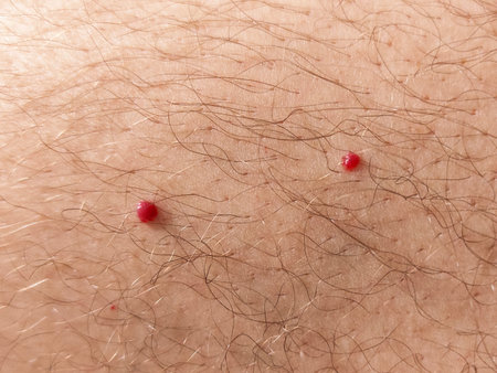 Close up photo of cherry angioma on human hairy skinの写真素材