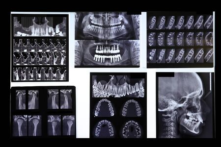 X-ray 3D a picture in stomatology for diagnostics and treatmentの写真素材