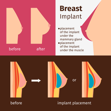 Breast augmentation infographics. Breast implants vector illustrationのイラスト素材