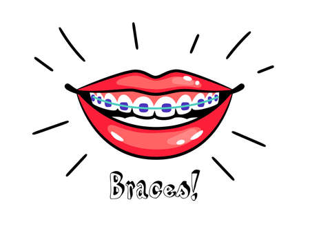 Orthodontic braces. Cartoon smile with dental braces, correct bite of teeth, vector illustration of medical orthodontic align and treatment for teeth in mouthのイラスト素材