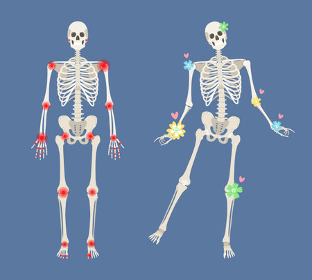 Recovery from autoimmune disease, healthy joints. Human skeleton with pain points in rheumatoid arthritis. Men anatomy illustration with a body silhouetteのイラスト素材