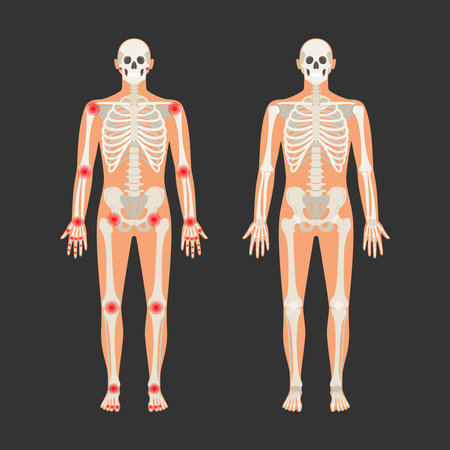 Human skeleton with pain points in rheumatoid arthritis. Men anatomy illustration with a body silhouette. Vector isolated flat of skull and bones in bodyのイラスト素材