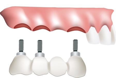 false teeth implantのイラスト素材