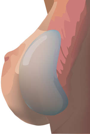 female breast implant cosmetic surgeryのイラスト素材
