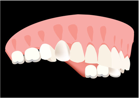 upper and lower palate dental apparatus dental prosthesis