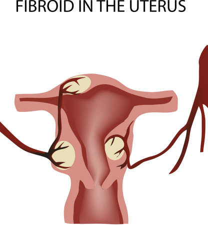 female organ tumor disease fibroidの素材 [FY310186991630]