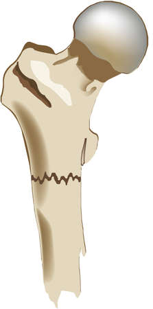 bone system human skeleton femoral fractureのイラスト素材