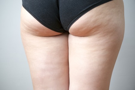 Fatty female hips. Skin care, cellulite. Obesityの写真素材