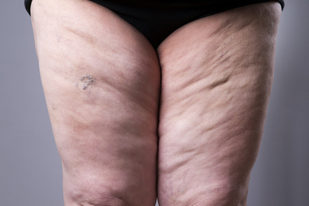 Varicose veins closeup. Thick female legs on a gray backgroundの写真素材