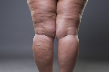 Varicose veins closeup, fat female cellulite legs on a gray backgroundの写真素材