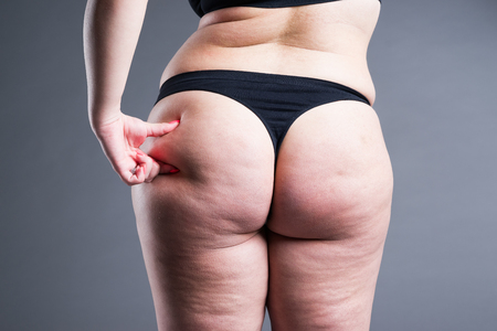 Fat female body with cellulite, overweight hips and buttocks on gray backgroundの写真素材