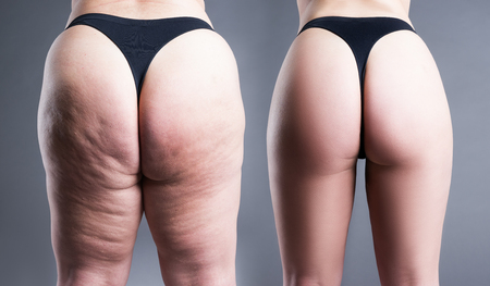 Overweight woman with fat legs and buttocks, before after concept, obesity female body on gray background, rear viewの写真素材