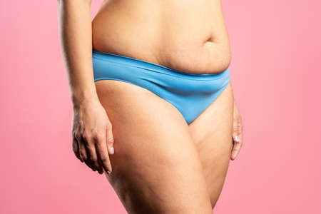 Tummy tuck, flabby skin on a fat belly, plastic surgery concept on pink backgroundの写真素材