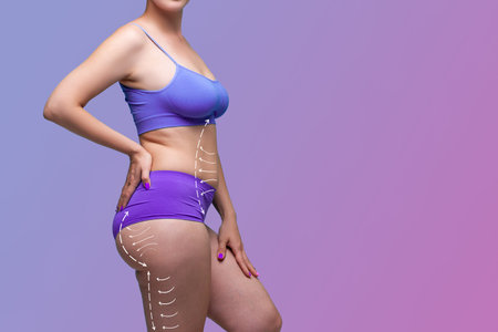 Leg, buttocks, abdomen liposuction, fat and cellulite removal concept, overweight female body with...