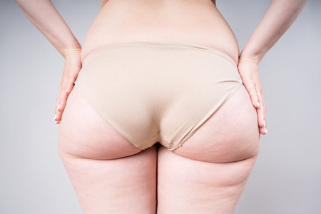 Overweight thigh, woman with fat hips and buttocks, obesity female body with cellulite on gray...