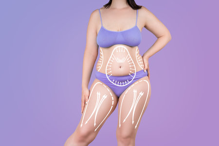 Legs and belly liposuction, fat and cellulite removal concept, overweight female body with painted surgical lines and arrows on purple backgroundの写真素材