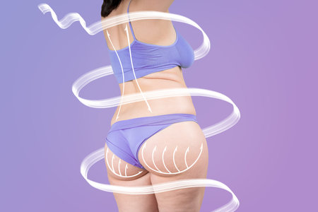 Buttocks, hip, back liposuction, fat and cellulite removal concept, overweight female body with painted surgical lines and arrows on purple backgroundの写真素材