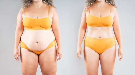 Tummy tuck, woman's fat body before and after weight loss and liposuction on gray studio background, plastic surgery conceptの写真素材