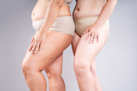 Two overweight women with fat flabby bellies, legs, hands, hips and buttocks on gray studio background, plastic surgery and body positive conceptの写真素材